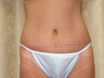 Tummy Tuck after Gastric Bypass