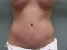 Tummy Tuck