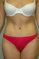 Tummy Tuck