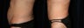 Tummy Tuck