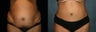 Tummy Tuck