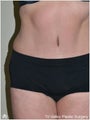 Tummy Tuck