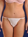 Abdominoplasty with Vaser Hi Def Liposuction of back and flanks
