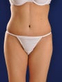 Tummy Tuck