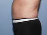 Tummy Tuck