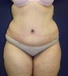 Tummy Tuck