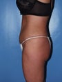 abdominoplasty with suction-assisted lipectomy