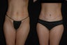Tummy Tuck
