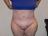 Tummy Tuck