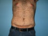 Male tummy tuck