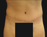 Tummy Tuck