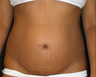 Tummy Tuck