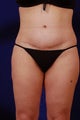 Tummy Tuck