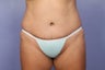 Tummy Tuck