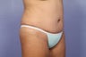 Tummy Tuck
