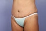 Tummy Tuck