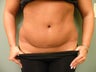 Abdominoplasty/Tummy Tuck 