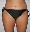 Tummy Tuck