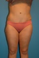 Tummy Tuck