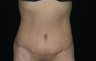 Tummy Tuck