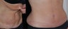 Full Tummy Tuck
