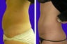 Bikini or Mini Tummy Tuck