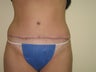 Tummy Tuck