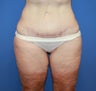 Abdominoplasty after bariatric surgery
