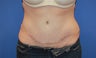 Tummy tuck with upper hip liposuction