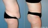 Tummy Tuck