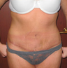 Tummy Tuck
