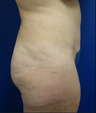 Tummy Tuck