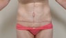 Abdominoplasty