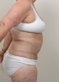 Panniculectomy with Abdominoplasty