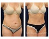 Abdominoplasty - Tummy Tuck