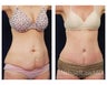 Abdominoplasty - Tummy Tuck