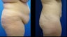 Tummy Tuck