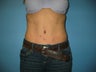 tummy tuck with liposuction