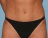 Tummy Tuck