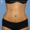 Tummy Tuck