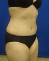 Tummy Tuck
