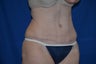 Tummy Tuck