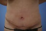 Tummy Tuck