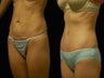 Tummy Tuck