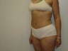 Tummy Tuck