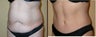 Tummy Tuck