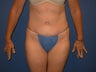 Tummy Tuck