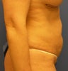 Tummy Tuck