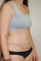 Tummy Tuck