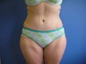 Tummy Tuck